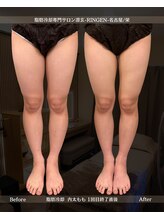 凛玄 名古屋栄店(りんげん)/脂肪冷却 Before After