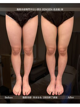 凛玄 名古屋栄店(りんげん)/脂肪冷却 Before After
