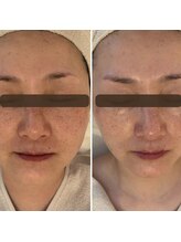 ランティル(l’until)/【ホホ・アゴがキュッと】