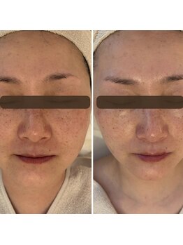 ランティル(l’until)/【ホホ・アゴがキュッと】