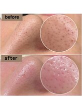 ティーティービューティ 名古屋金山店(TTBeauty)/毛穴エクストラクション