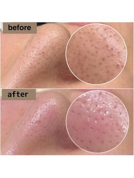 ティーティービューティ 名古屋金山店(TTBeauty)/毛穴エクストラクション