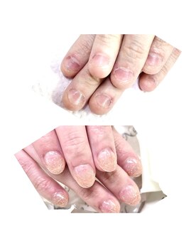 ヒロネイル(Hiro Nail)/深爪矯正9980円～11480円