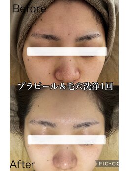 マーレン(Malen)/プラピール症例写真