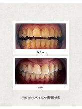 ホワイトニングショップ 福岡香椎店/美容ホワイトニング