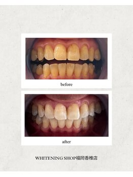 ホワイトニングショップ 福岡香椎店/美容ホワイトニング