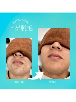 髭ラボ(髭LABO)/ヒゲ脱毛☆肌質改善