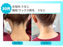 ムーンサン(Moon sun)/うなじ　ワックス脱毛