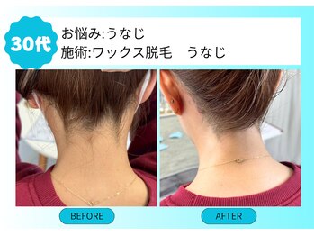 ムーンサン(Moon sun)/うなじ ワックス脱毛