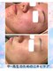 エステルクリア(esther clear)の写真/中高生必見！思春期ニキビ卒業へ☆透明感あふれる素肌へ♪