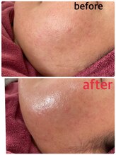 ホナ(HONA)/ピーリング後ハリツヤが違う