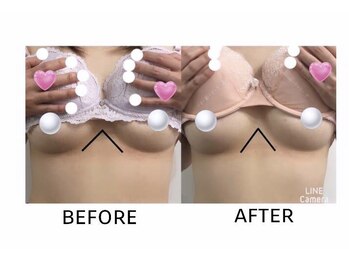 ミリミリ(mili mili)/バスト施術