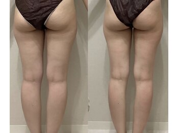 ワイグレイス(Y.GRACE)/ヴィーナスディーバ（4D痩身）