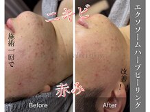 グロウ(glow.)/施術直後！ニキビ肌にお悩みの方