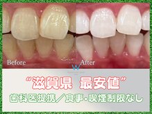 ホワイトニングショップ 甲賀店