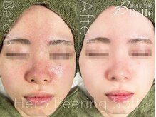 ベル 栄(Belle)/ハーブピーリング｜ニキビケア