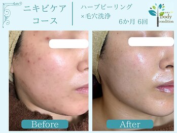 ボディコンディション/ハーブピーリング/毛穴洗浄/小顔