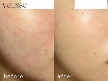ヴェリス 福岡店(Velisse)/ニキビケア・敏感