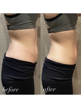 ビュウナ 銀座(BEAUNA)/脂肪冷却/frozen8