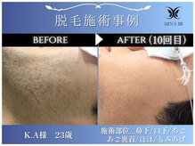 メンズビービー 福井高柳店(MEN'S BB)/ヒゲ脱毛施術事例