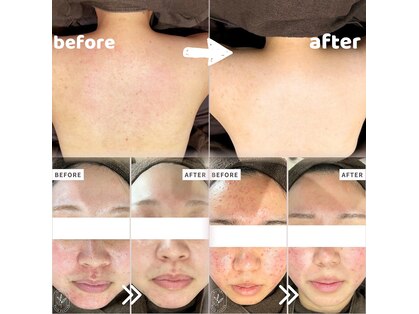 ハルミハーブピーリング 池袋店(Harumi Herb Peeling)の写真