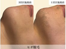 レオンザビューティー(REON the BEAUTY)/症例写真│ヒゲ脱毛