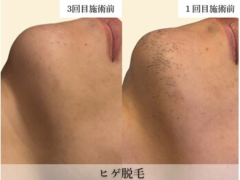 レオンザビューティー(REON the BEAUTY)/症例写真│ヒゲ脱毛