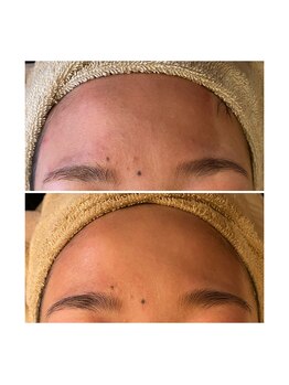 アクアンフィニィ(aquanfini)/肌育でおでこもピカピカに★