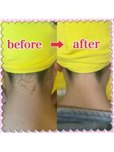 ミミーモリオカ(MiMiy MORIOKA)/フォトRF脱毛1回