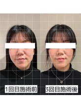 ヴィーライン 大阪梅田院(VeLine)/鍼灸／美容鍼／小顔／大阪／梅田