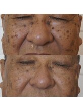 エトル(etole)/70代お客様症例写真