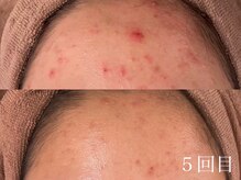 ホワイトアクア 四日市店(WHITE AQUA)/毛穴改善ハーブピーリング