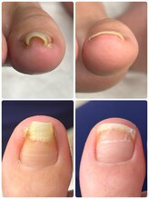 巻き爪矯正センター 沖縄 宜野湾/巻き爪矯正