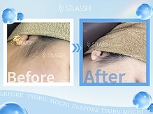 ストラッシュ 那覇アネックス店(STLASSH)/施術例：もみあげ