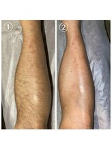 サロン アンド ビューティーエス(Salon&Beauty S)/脱毛効果【ヒザ下】