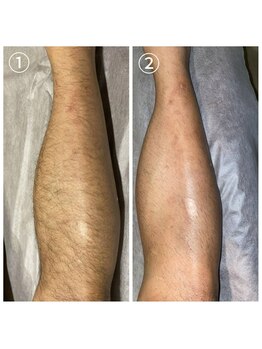 サロン アンド ビューティーエス(Salon&Beauty S)/脱毛効果【ヒザ下】