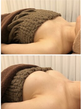 リール 新宿店(RIRE)/20代後半 バストアップ症例