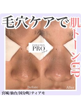 ティアモ(Ti Amo)/額も鼻も毛穴レスに！