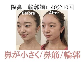ラプリ 大阪心斎橋店(Raplit)/隆鼻＋輪郭矯正40分10回