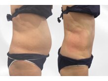 プリマルーチェ/プレミアムお腹プログラム