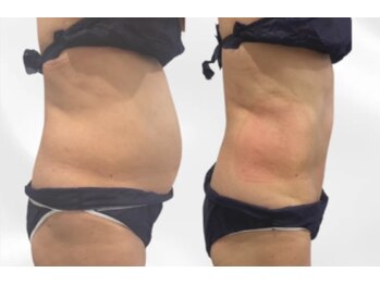 プリマルーチェ/プレミアムお腹プログラム