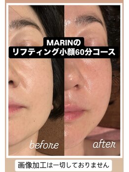 ボディーケアサロン マリン(Body Care Salon MARIN)/糸リフト級の小顔メソッド
