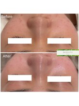 クレア(Clair)/ビオフィート症例