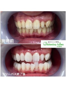 ホワイトニングサロン 名古屋駅店/【ホワイトニング施術例】