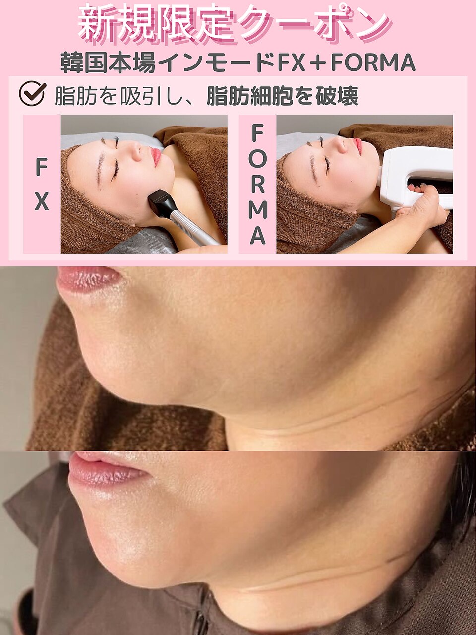 【人気NO1★韓国トレンド/即効小顔】インモード！FX＋FORMA13000円