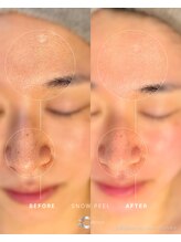 ラ メール(La mer)/★雪花ピール1回の効果★