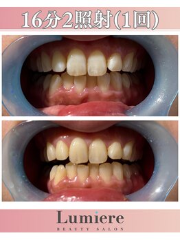 ルミエール 南郷通7丁目店(Lumiere)/16分２照射超時短ホワイトニング