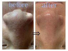 リジュベ(Rejuve)/毛穴洗浄/ブライダル/船橋/毛穴