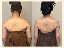 ラフリー 天神赤坂院(RUFFREE)/背中美人に大変化【天神赤坂】