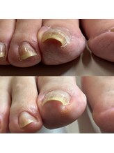 リリ(lili)/巻き爪矯正2回目（右親指）